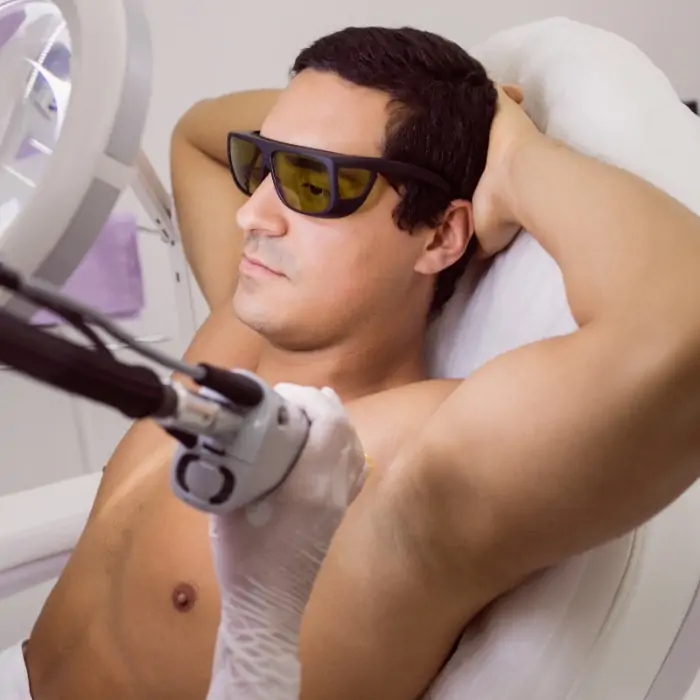 depilação a laser em homens