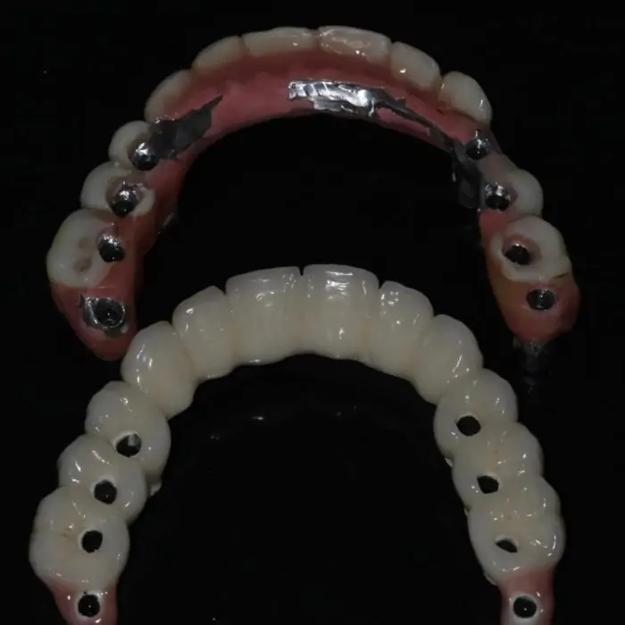 Implante Dentário Juiz de Fora 